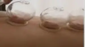Dry Cupping