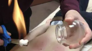 Fire Cupping