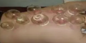 Static cupping: The patient passively lies on a bed and the cups are just left on