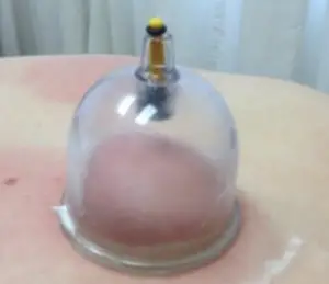 Sucking evil spirits? Stimulating chi? Increasing blood flow? Releasing tight tissues?